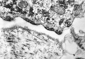 M, 22y. | epidermolysis bullosa - junctional type M, 22y. | epidermolysis bullosa - junctional type